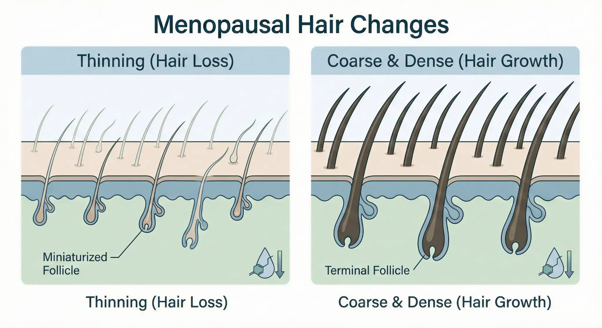 Menopausal Hair Changes — Thinning vs. Dense follicle diagram